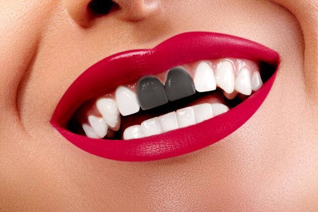 terapia_canalare_devitalizzazione